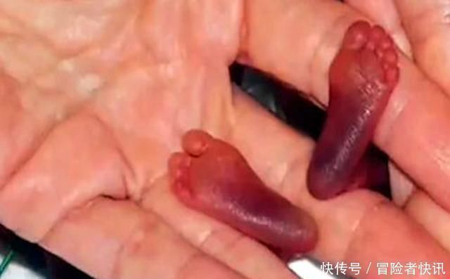 早产|14年过去,原本身体巴掌大“世界最小宝宝”,如今颜值高到认不出