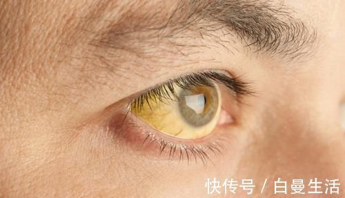 肝脏|肝不好“眼”先知！一旦眼睛有这2种“迹象”，很有可能是肝癌！