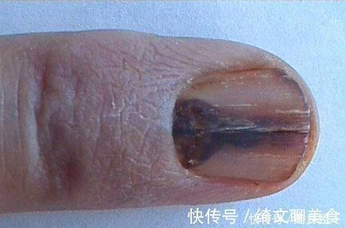 黑线|指甲里的黑线是什么？真有1种可能会癌变，不是开玩笑，别小瞧