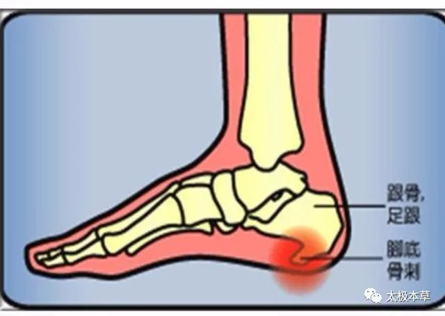 骨刺|足跟骨刺,疼痛巨甚,用此1味药煎汤泡脚1个月可痊愈