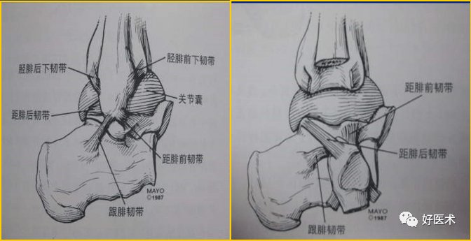 脚踝韧带断了严重吗