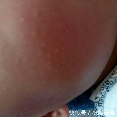 脸上都是小米粒痘痘怎么办唯诺雅教你快速简单的方法