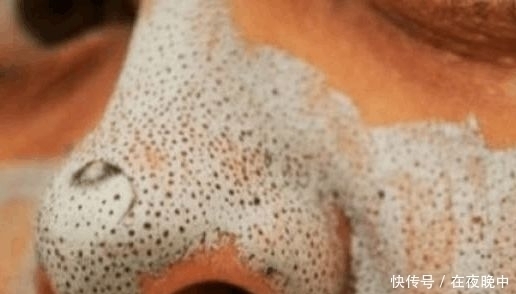 鼻子上的“白米粒”越挤越多,皮肤还会凹下去,原来是它的分泌物