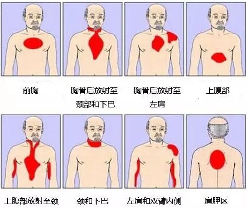 男性|安贞医院汇总10年数据发现：年轻“心梗”患者里，95%是男性