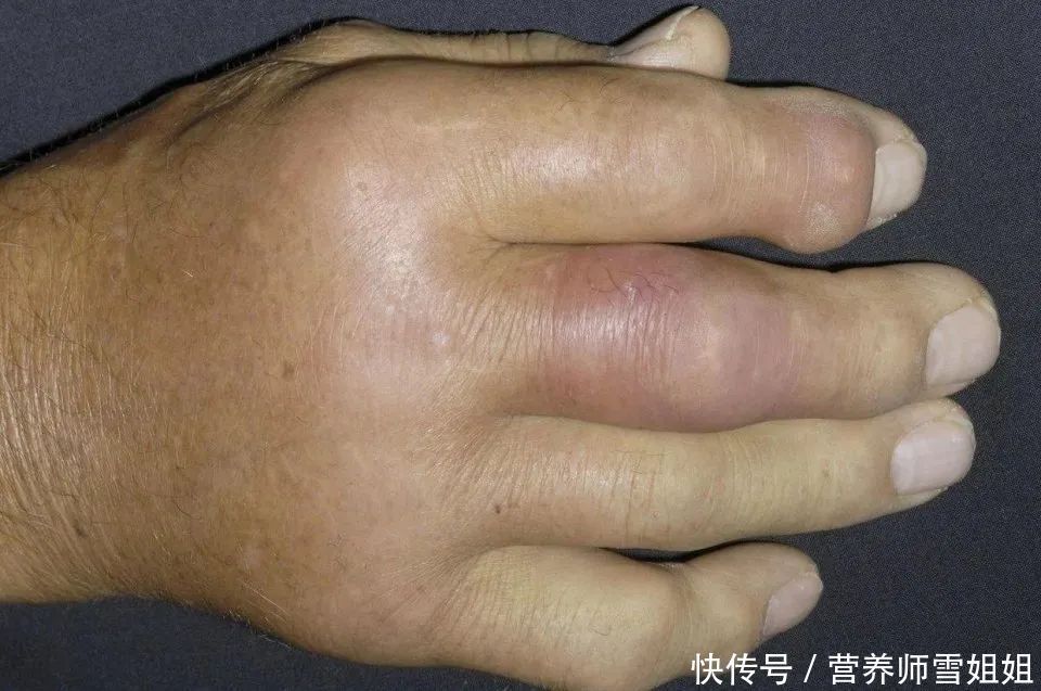 发病|冬季,痛风高发,这4类人,一旦出现3个症状,尿酸高的可怕了