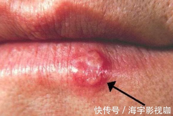 蒲公英水|17岁女生因一壶蒲公英水,送入医院,提醒蒲公英泡水有4大禁忌