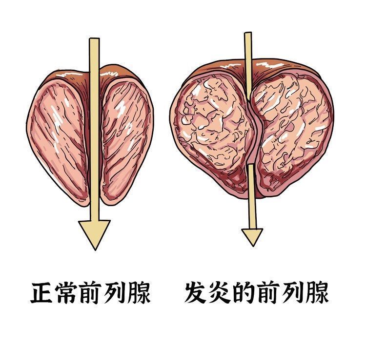 前列腺增生|提醒男性：50岁后不想被前列腺增生“盯”上，这4件习惯要坚持