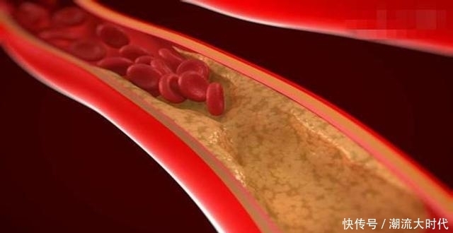 血管不好难长寿,多吃3菜,做好3事,养血管,防止血管硬化