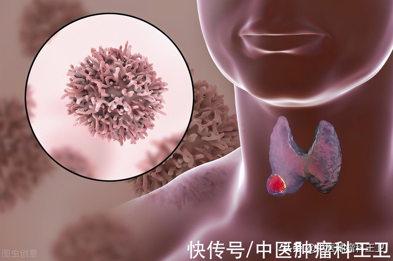 中醫|甲狀腺癌術后上吐下瀉，中醫：“懶癌”術后調理非常關鍵