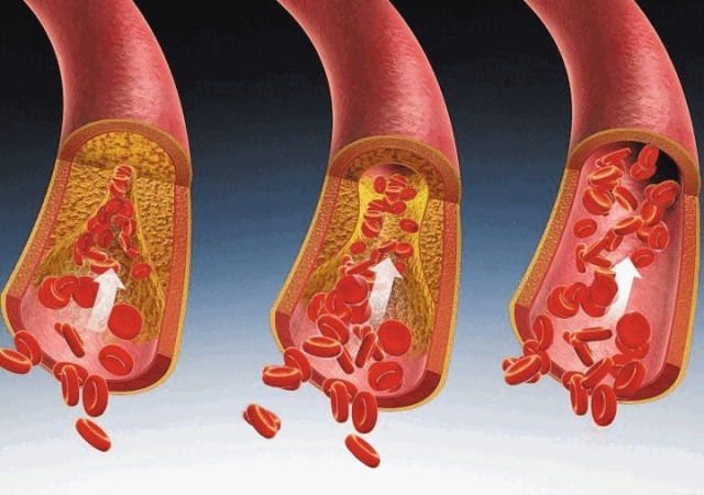 血液流变学|3个中成药，活血化瘀通络，抗动脉硬化，从根上改善冠心病和脑梗