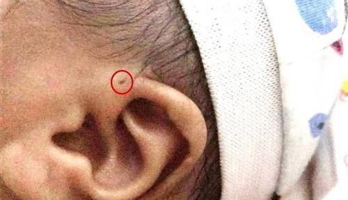 富贵洞|你家宝宝耳朵上有“富贵洞”吗?如果有,家长们可要多留心了