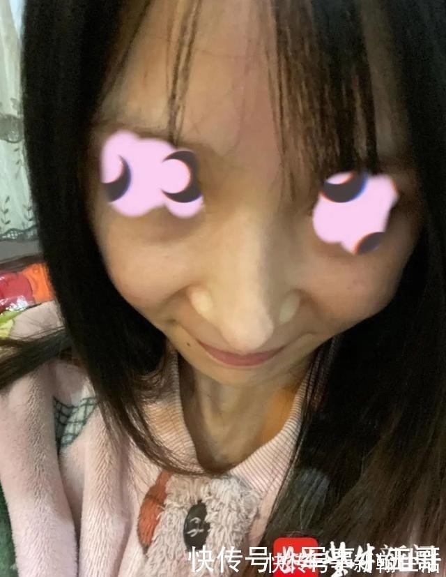 昆山 女子整容后山根晃动、鼻尖发白!手术方:很成功,已起诉