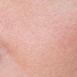 缩毛孔效果不大？对抗毛孔问题还是得来点硬的