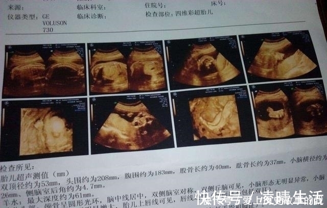 宝宝|四维彩超，孕妈们最期待的产检，除了看宝宝的照片还需要看什么？