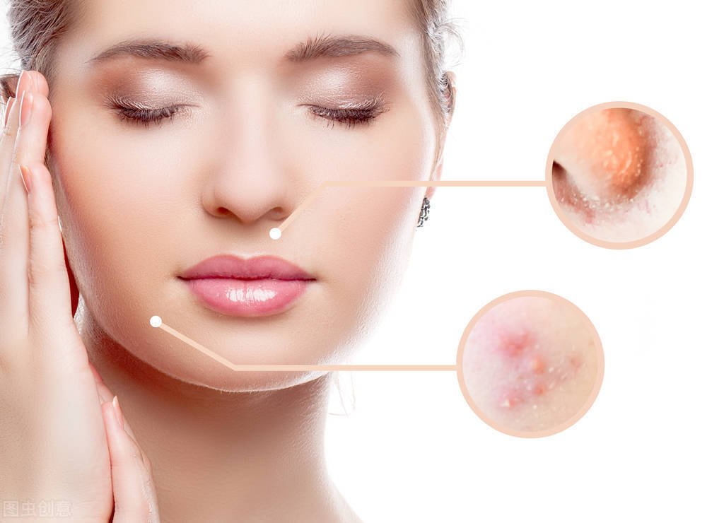 高糖分|好雨时节:油性皮肤如何改变成正常肤质?