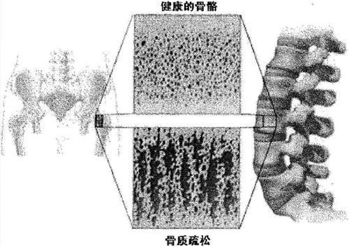 骨密度|骨质疏松还在盲目吃钙片先做到这3点,把骨头慢慢“养”好