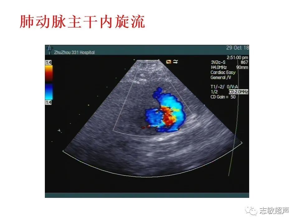 超声|肺动脉瓣周边异常血流的超声鉴别