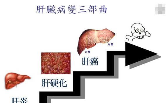 竖中指|刚开始得肝癌往往没有感觉，不妨试一下“竖中指”，一看就明了