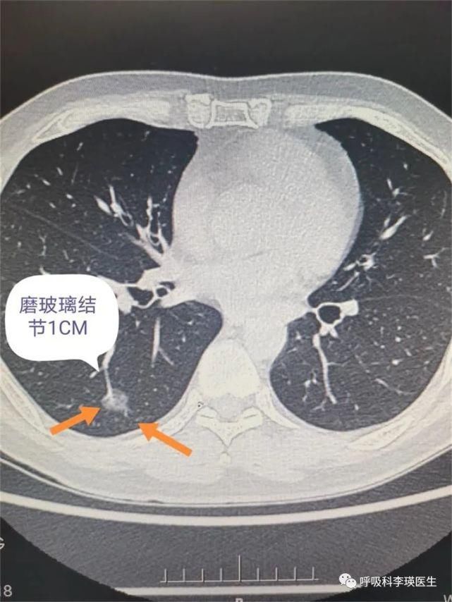 肺部CT多久做一次合适？这些肺部CT通俗易懂的解释，建议收藏