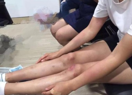 皮肤|身体一碰就淤青,可能患上了此3种病,男女都应该了解