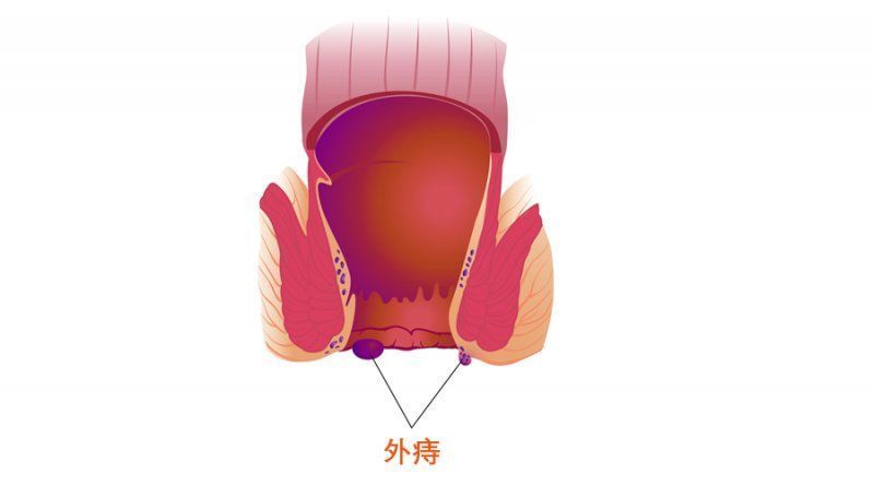 混合痔|关于“痔”，您是否有很多问号？