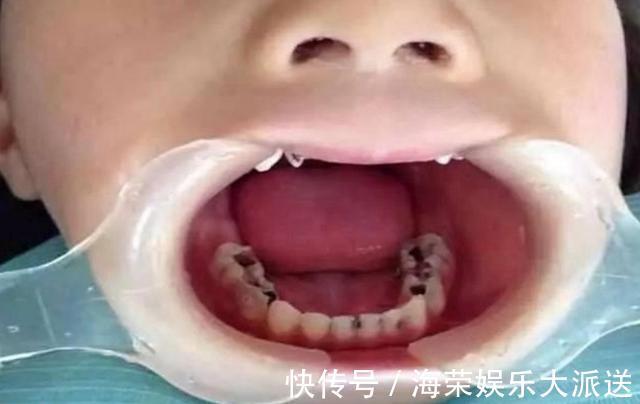 罪魁祸首|妈妈每天偷懒三分钟,3岁女娃竟满口“黑牙”,罪魁祸首不是糖果