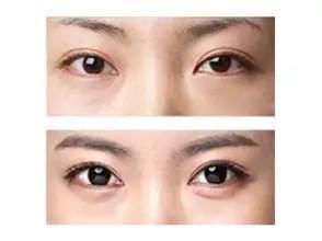 如何区分眼袋、泪沟、卧蚕？