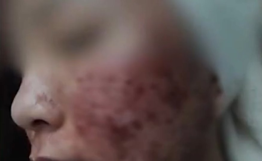 警方|女孩打瘦脸针导致毁容,整形医生经调查,仅仅受培训五天