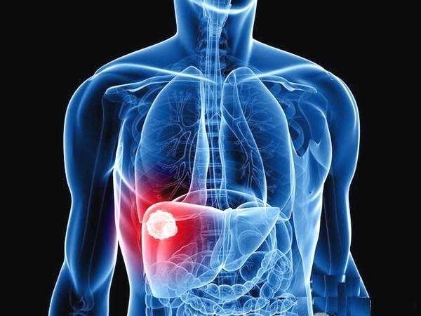 淋巴结|癌症转移分为3种情况，有2种情况可以治愈，快来看看你是哪一种