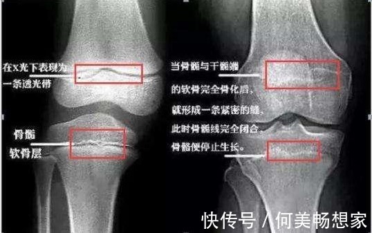 长高|家长如何分辨,孩子是属于个子矮,还是晚长个呢医生说看这3点
