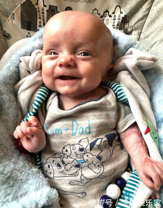 防腐剂|19岁女孩早产生下宝宝，宝宝全身没皮肤，护士都不敢抱