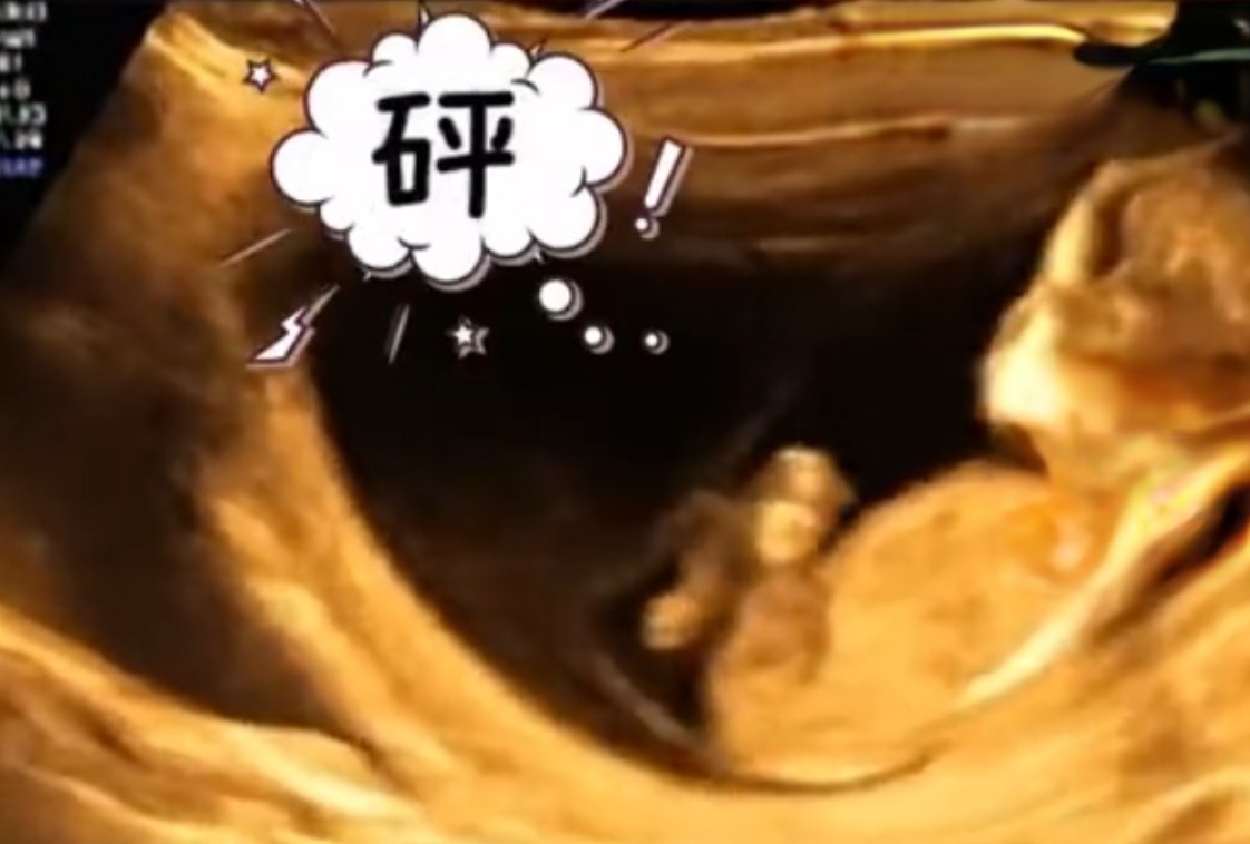 忍俊不禁|孕妈做四维彩超时突然腹痛,B超显示让人忍俊不禁,网友:挺无辜