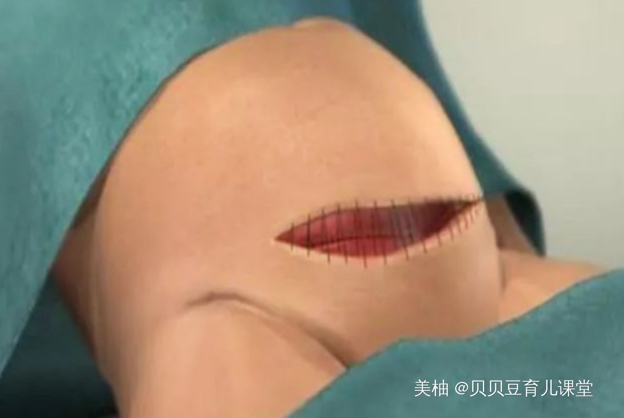 流程图|看过这几张剖腹产模拟流程图,产妇更害怕了,网友确实很形象