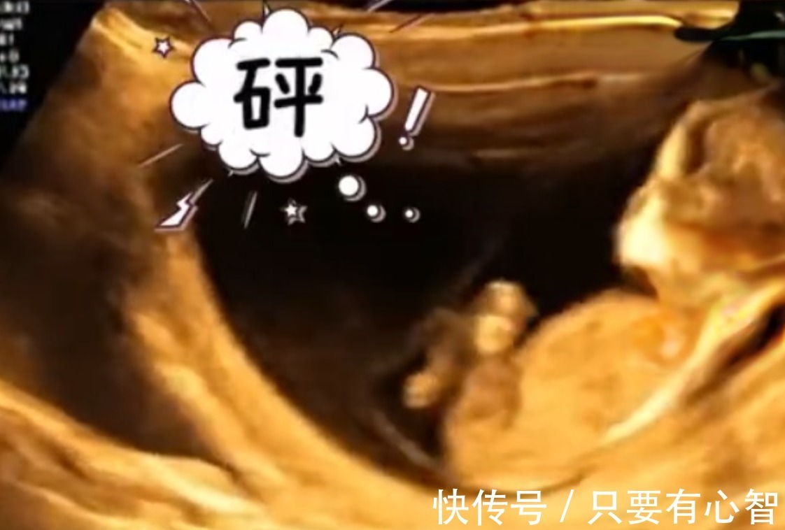 四维彩超|孕妈做四维彩超时突然腹痛,B超显示让人忍俊不禁,网友:挺无辜