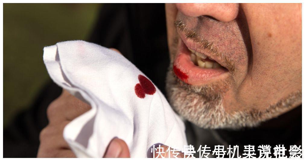 王大哥|肺结节患者越来越多 平常多吃3黄, 或有助于结节消散