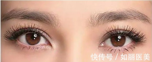 眼部 全切双眼皮多久能恢复正常?术后效果怎么样?快来看看吧