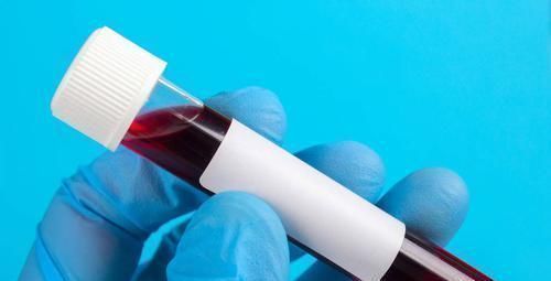 老高|前列腺有癌,小便先知,排尿若出现三个特征,最好去检查PSA