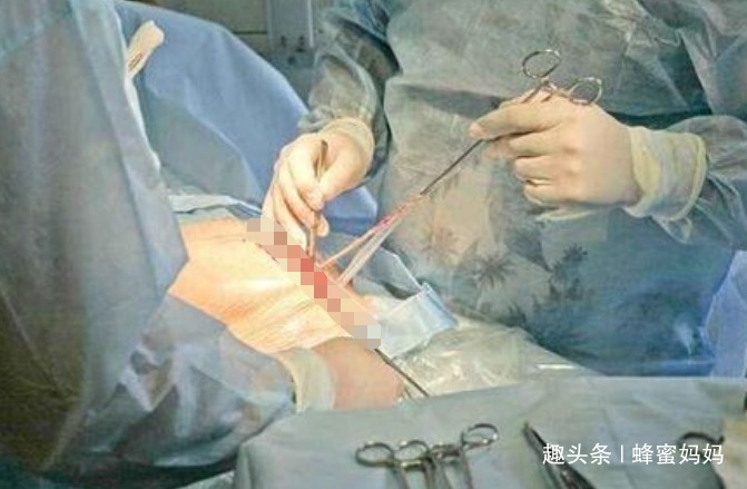 肚子|产妇刚生完娃,肚子仍“鼓的”像怀孕8个月,医生手术后对不起