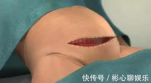 手术|剖腹产到底要挨几刀没你想的那么简单,只有经历过的人才懂