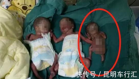 医生|产妇生出双胞胎后,突然大喊“等一下”!医生检查后发现有惊喜