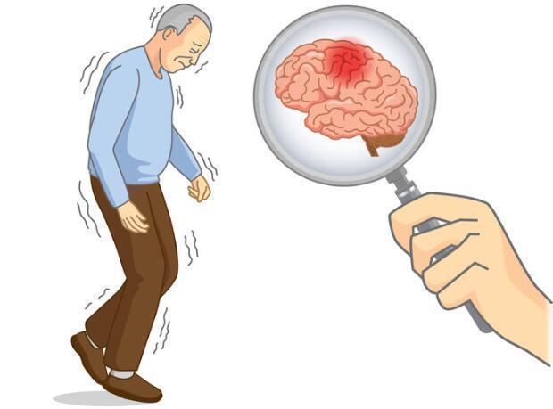 发育不良|身体出现四个异常信号，或与颈动脉狭窄有关，发现后，谨防脑梗