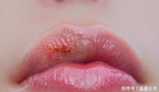 無論男女,如果嘴上出現(xiàn)了“它”,可能是體內(nèi)免疫力要下降了