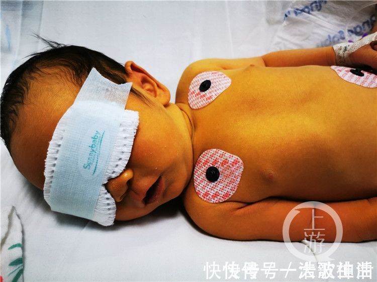 胆红素|“熊猫血”宝宝出生仅两天 换了四次血终于救回来了!