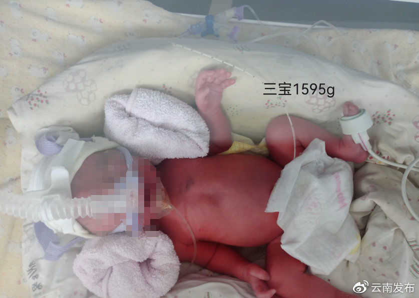 瑞丽|全国首例新冠肺炎确诊三胞胎孕妇在瑞丽顺利生产