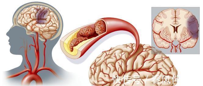 同型半胱氨酸|美国肥胖者如此多，为何脑梗死的发病率低于我国？医生：三大原因