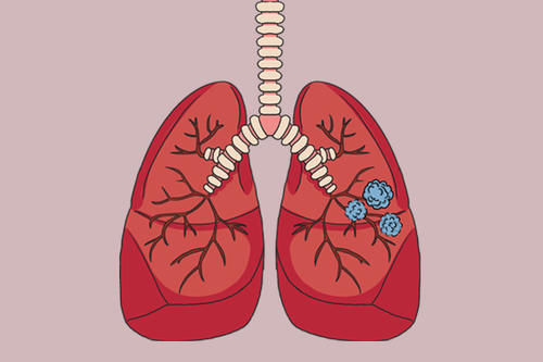 肺部发现7个结节，意味着转移？医生详细做出分析，早了解