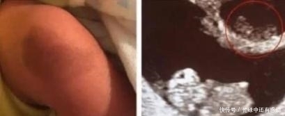 胎记|双胞胎姐姐在腹中被“吸收”,化为胎记留在弟弟腿上,令人动容