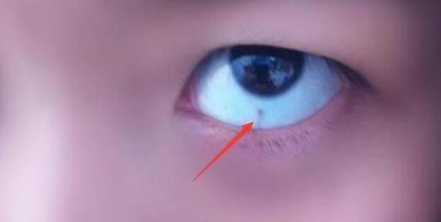 眼白|3岁宝宝眼白出现黑点,怎么回事儿听了医生的答案,终于放心了