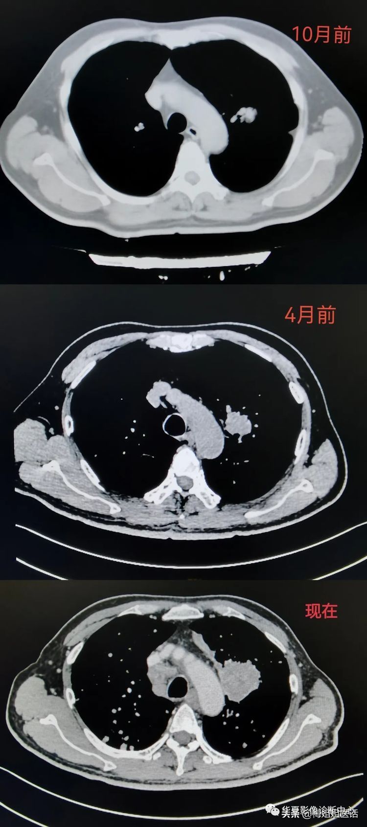 患者|从肺结节到肺癌，10个月影像记录，提醒我们正确对待肺结节处理