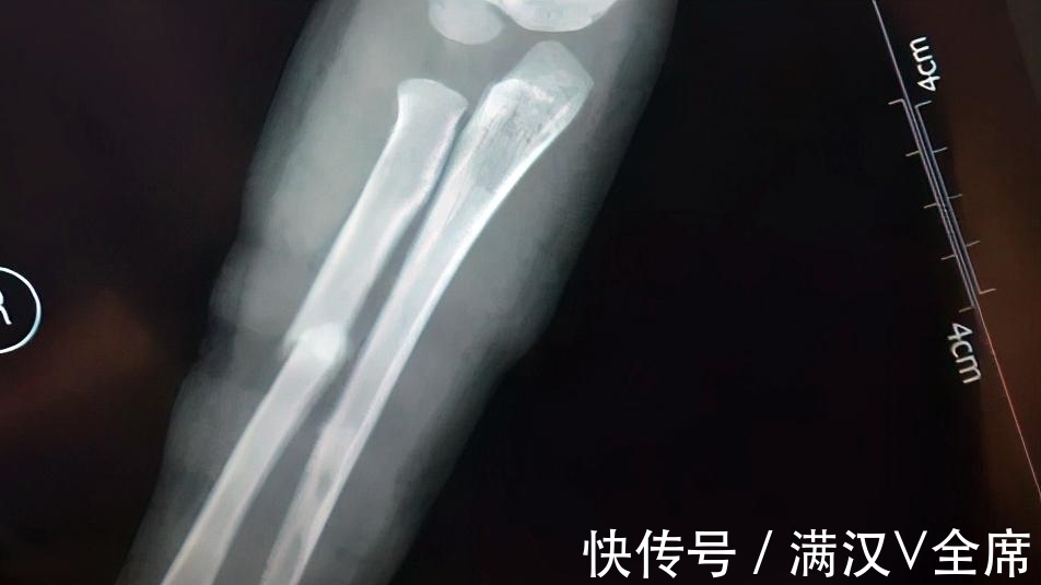 滑梯|5岁孩子“逆行”上滑梯，被迎面滑下的大孩子推倒摔骨折，竟被指家长没教育好